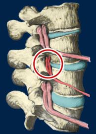 Subluxation Degeneration